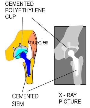 Cemented THP